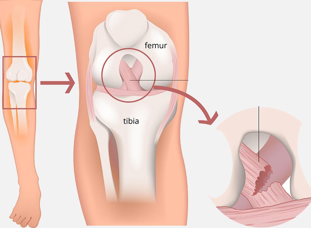 ligaments croise antérieur