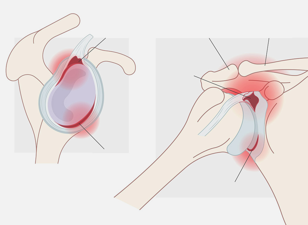 pathologie stabilisation épaule