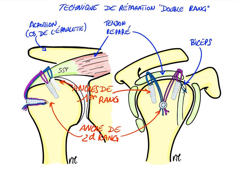 Suture de la coiffe