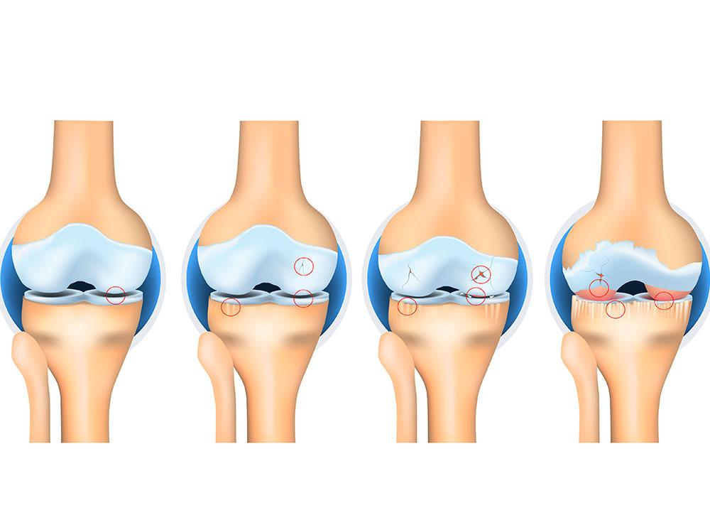 arthrose genou
